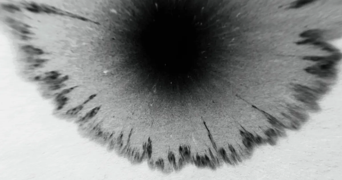 Close-up em preto e branco de uma íris com áreas escuras de pigmentação ao redor da pupila, ilustrando a melanocitose oculodermal.