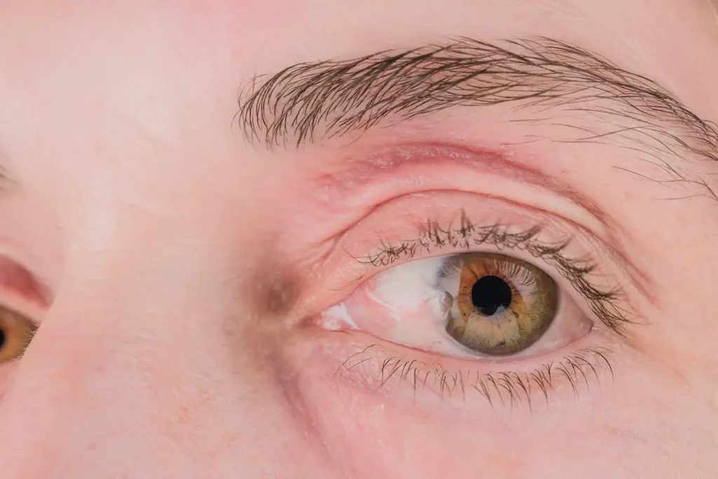 Close-up do olho de uma pessoa branca, com íris verde-avelã e uma pequena membrana esbranquiçada avançando da parte interna do olho em direção à córnea, imagem que ilustra o pterígio.